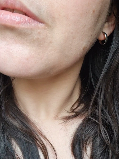 avant-apres-anti-imperfections-neat-circles-apres